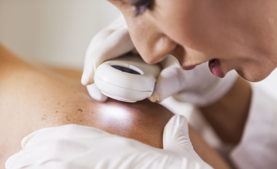 How to Choose the Right Melanoma Dermatologist for Your Skin Health